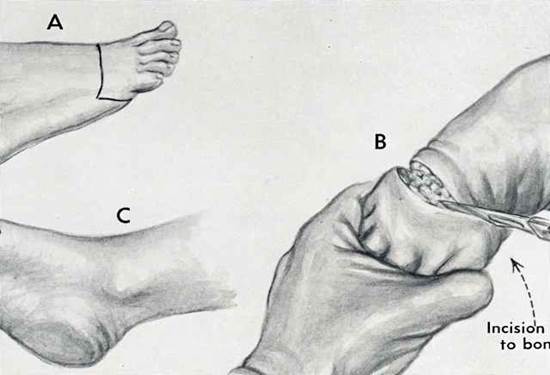 how long is recovery from below knee amputation