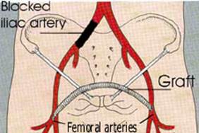 Bypass Surgery